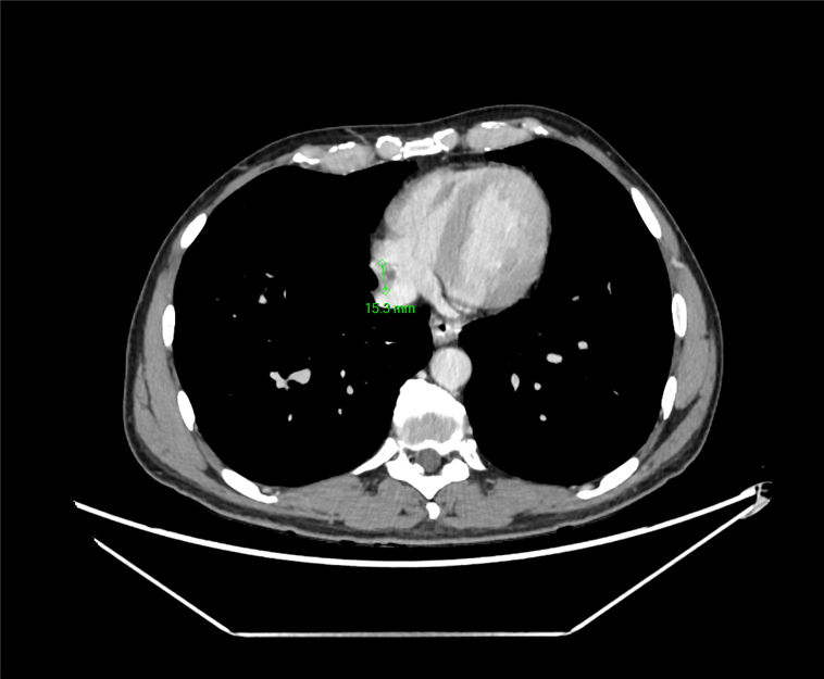 June 2024, tumor image